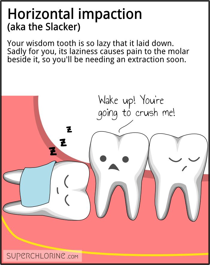 wisdom teeth care instructions