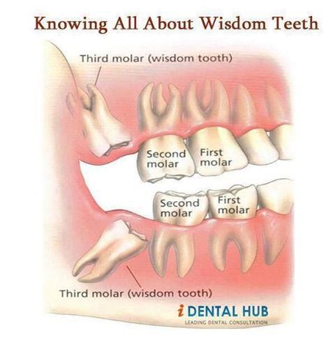 wisdom teeth care instructions